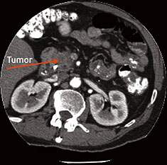胰腺癌肿瘤的CT影像
