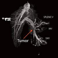 MRCP过程中胰腺癌肿瘤的图像