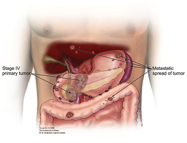 阶段4胰腺癌，胰腺外肿瘤和转移