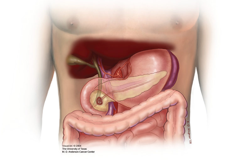 腹部区域的插图描绘了在咀嚼手术前与肿瘤的胰腺头。