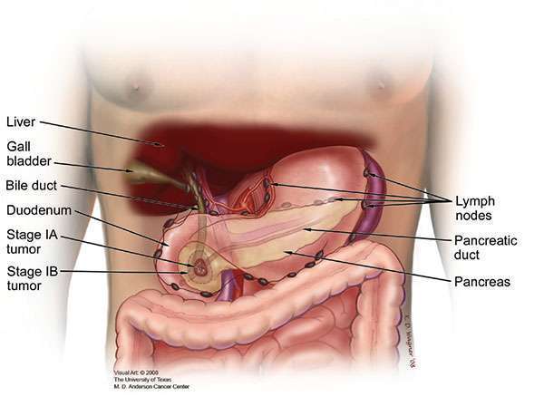 I期肿瘤局限于胰腺，通常可以通过手术切除。