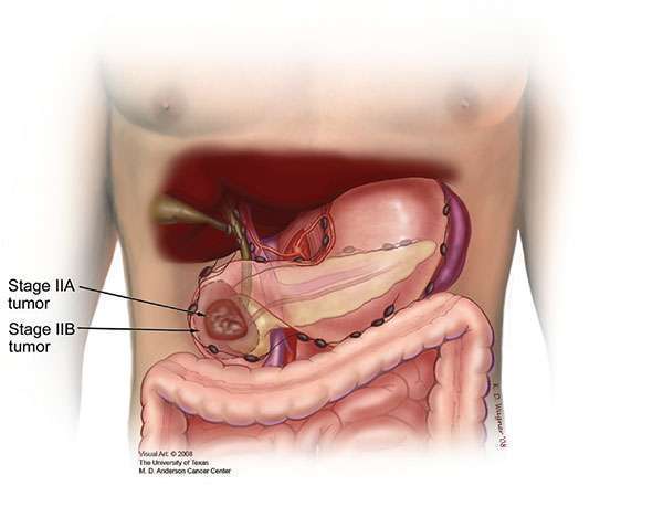 II期肿瘤可能延伸或不延伸到胰腺以外，也不累及局部大动脉。